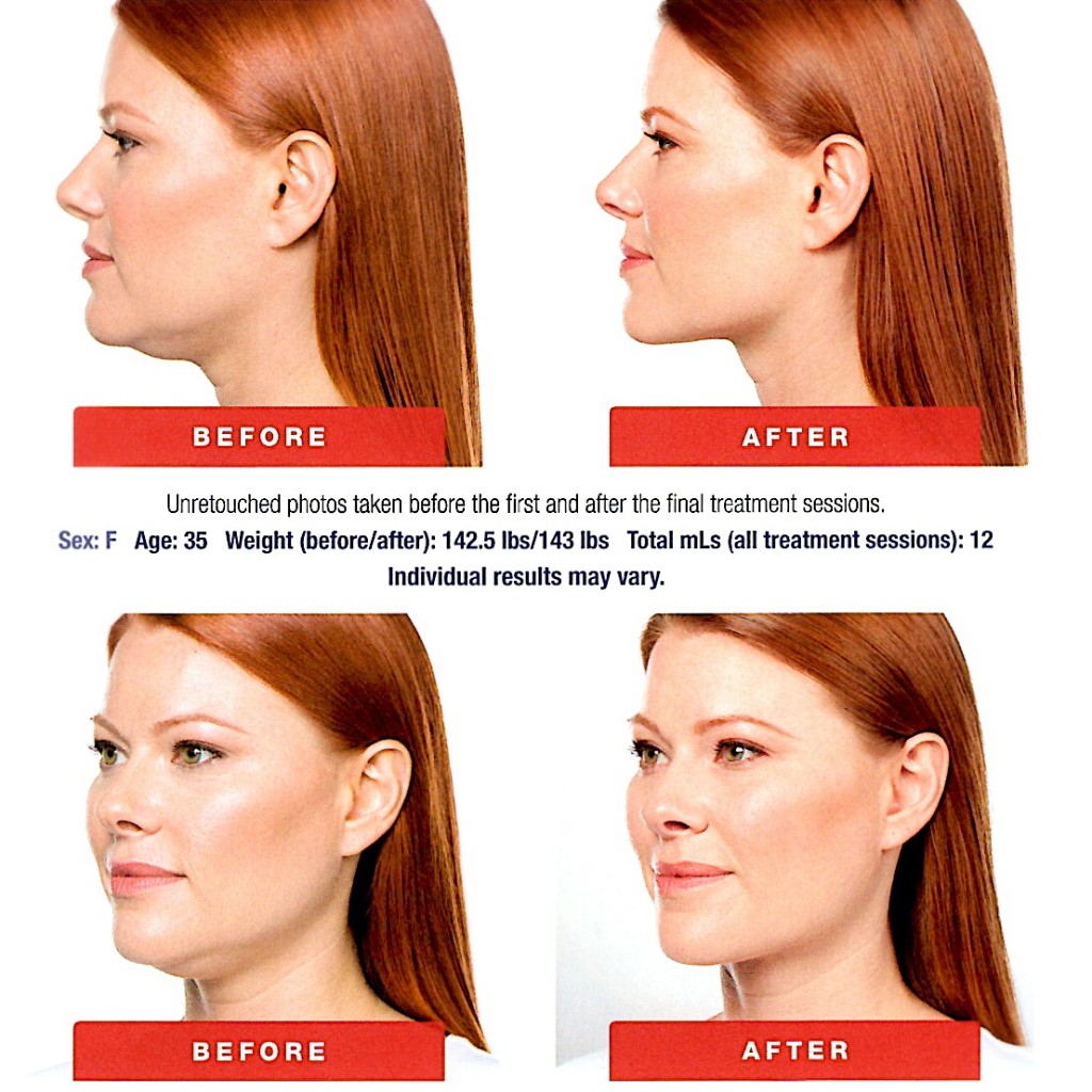 Kybella Charleston neck