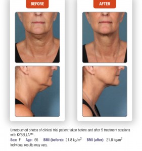 kybella charleston sc