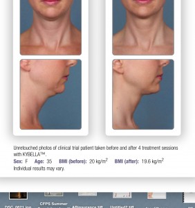 kybella charleston sc