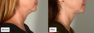 kybella double chin