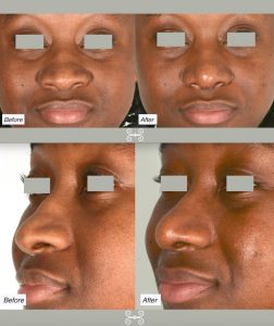 ethnic rhinoplasty in Charleston, sc