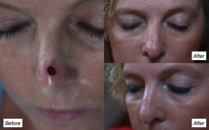 skin cancer on nose