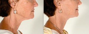 charleston neck lift