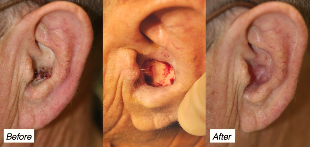 ear skin cancer