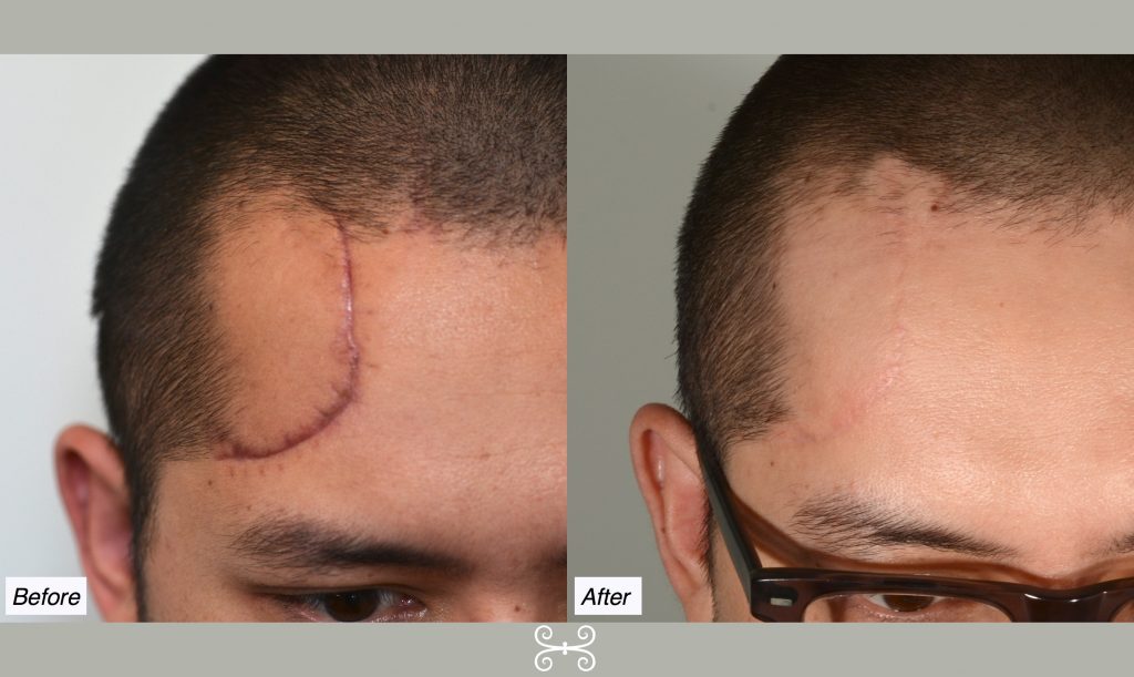 scar revision