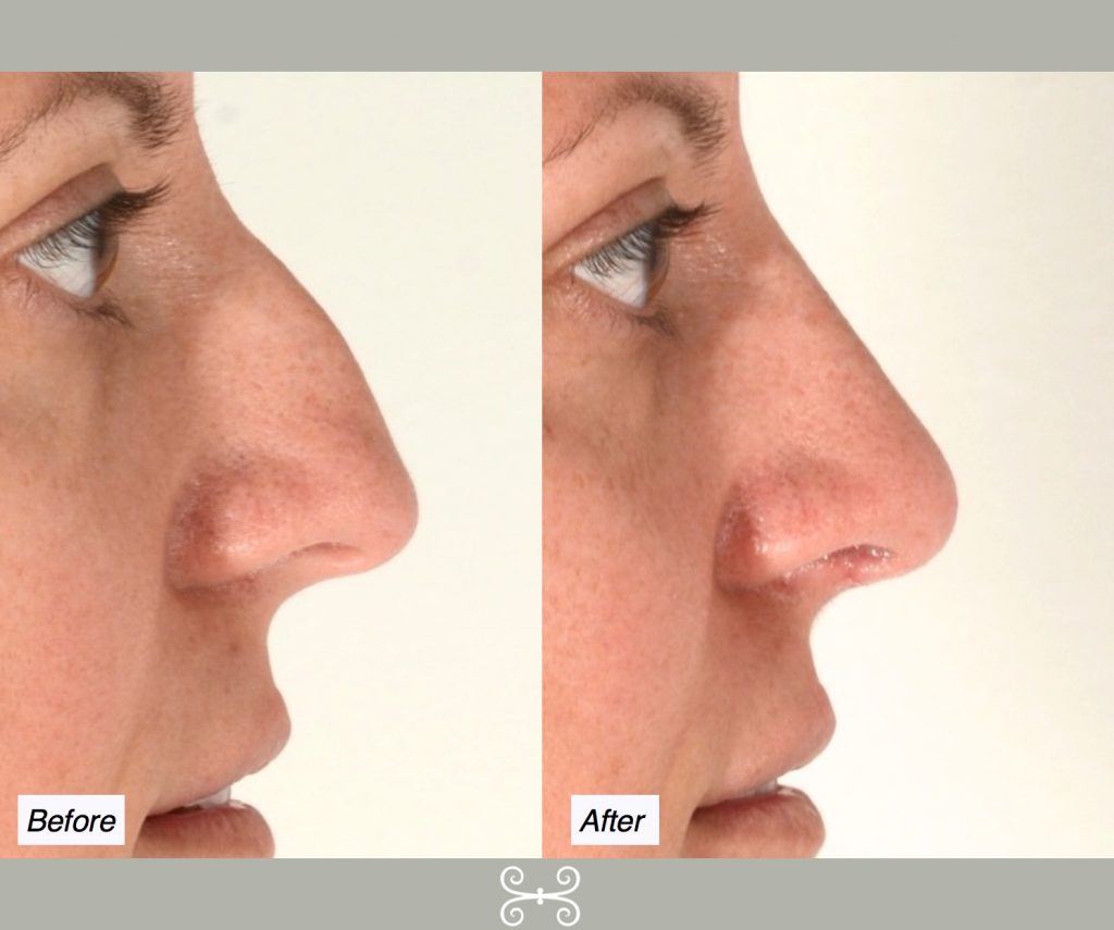 nose job hump reduction