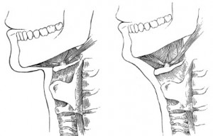 low hyoid neckline