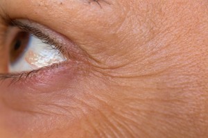 Crows Feet, Botox cream