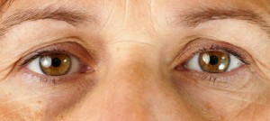 eyelid surgery Charleston