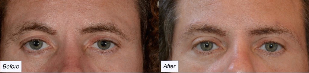 charleston eyelid lift, browlift