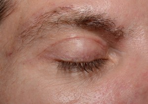 eyelid lift charleston