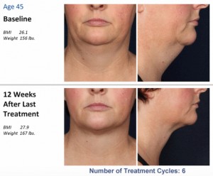 kybella weight gain