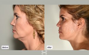 necklift in charleston, sc