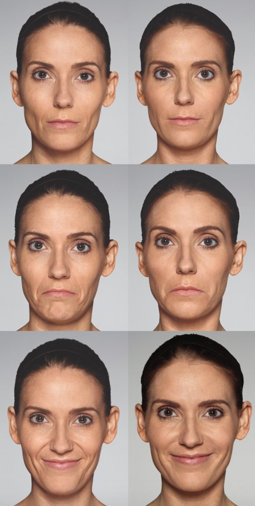 Restylane Defyne results