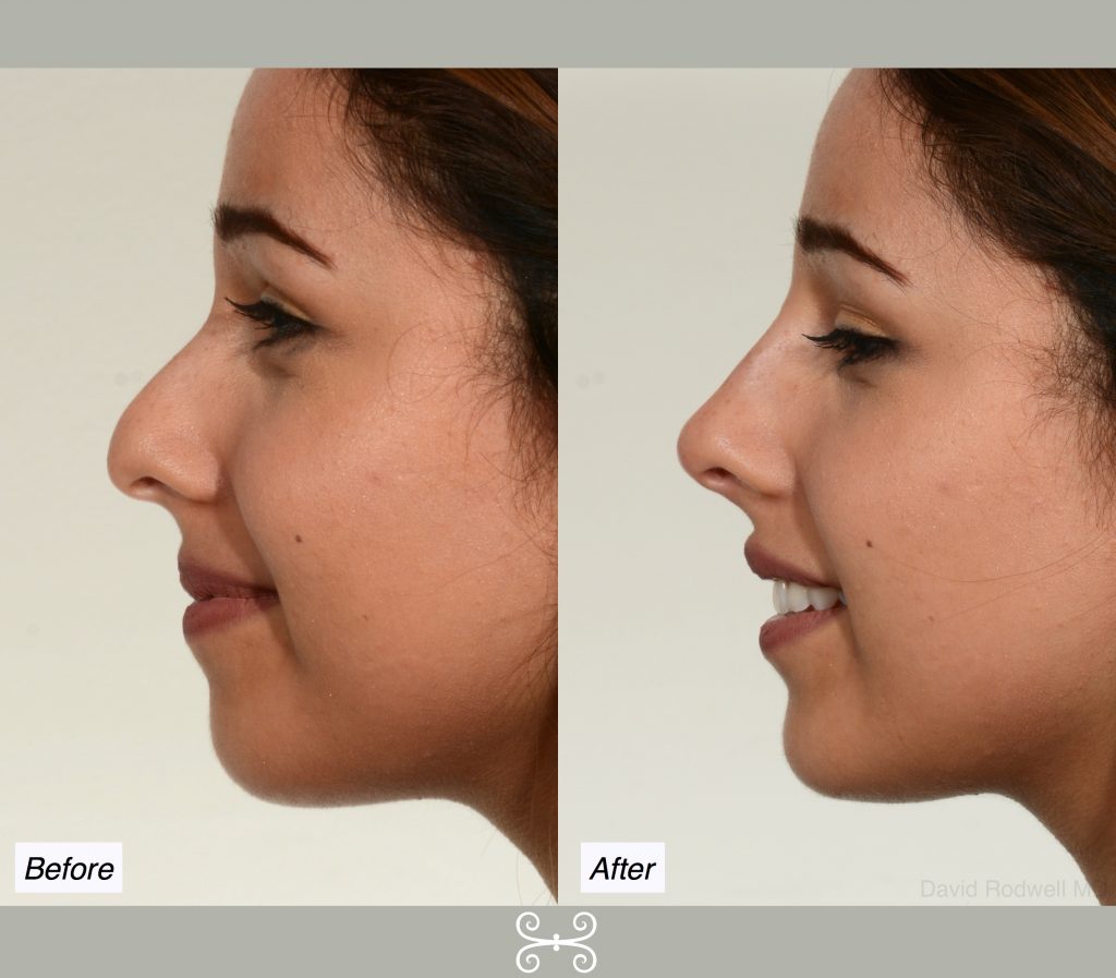 Charleston SC non-surgical nose job